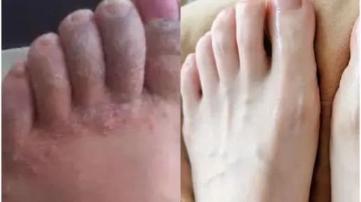 脚上起小水泡很痒是什么原因（脚上起小水泡,痒的厉害怎么办）