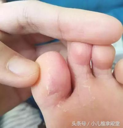 脚上怎样分辨是脚气还是湿疹(女性脚气初期图片) 脚上怎样分辨是脚气还是湿疹(女性脚气初期图片)